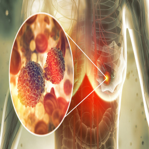 Breast Cancer Screening Breast Cancer Screening