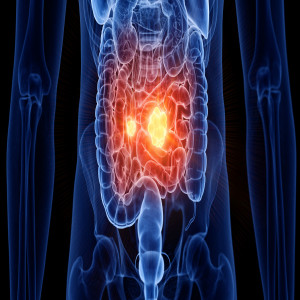 Colorectal Cancer Screening Colorectal Cancer Screening