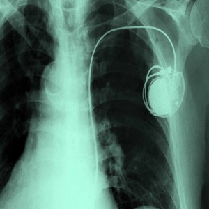 Global Next Generation Pacemaker & ICDs Market Global Next Generation Pacemaker & ICDs Market