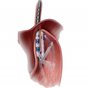 Global GERD Drug and Devices Market  Global GERD Drug and Devices Market