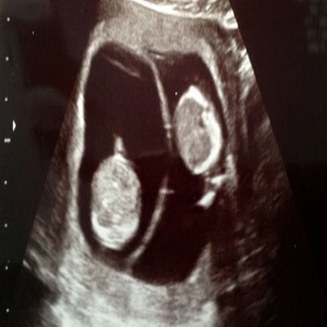 Global Non-Invasive Prenatal Testing (NIPT) Market Global Non-Invasive Prenatal Testing (NIPT) Market