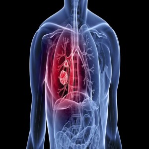 Global Cancer Imaging Systems Global Cancer Imaging Systems