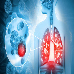 Extensive stage small cell lung cancer Extensive stage small cell lung cancer